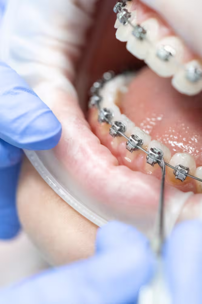 03_25 Do Braces Hurt_ What to Expect During Orthodontic Treatment 2 03 25 Do Braces Hurt What To Expect During Orthodontic Treatment 2